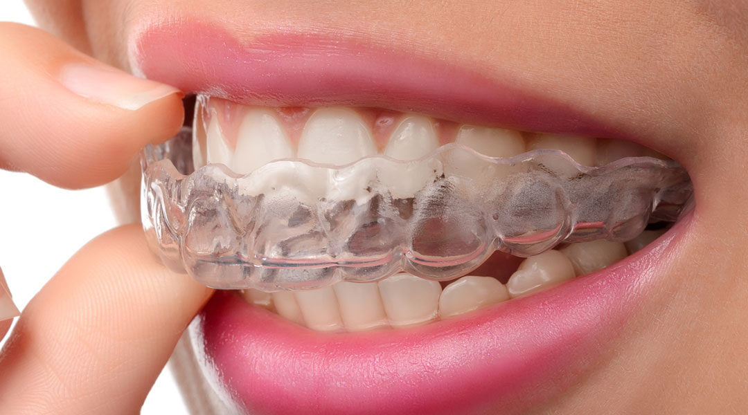 Invisalign Near Me | Braces vs. Invisalign