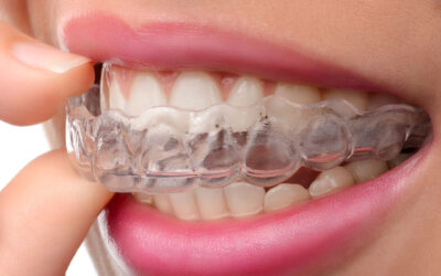 Invisalign Near Me | Braces vs. Invisalign