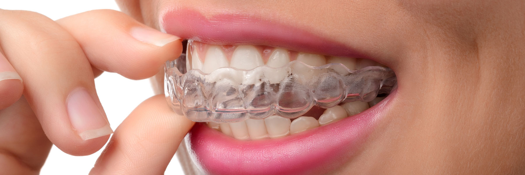 Invisalign Near Me, Invisalign Greenville SC
